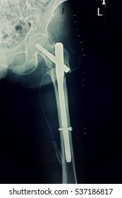 Xray Image Show Post Operation Total Stock Photo 537186817 Shutterstock