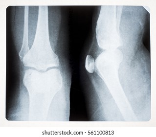 Xray Image Knee Lateral View Showing Stock Photo Edit Now