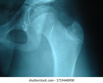 Arthritic Hip Xray Test Scan Orthopedic Stock Photo Edit Now 361270607