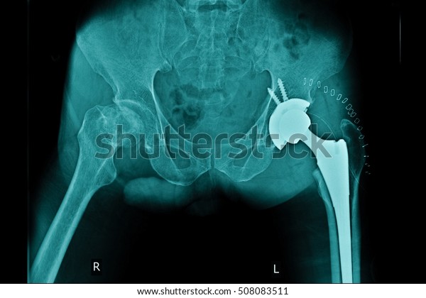 Xray Post Operation Total Hip Arthroplasty Stock Photo Edit Now