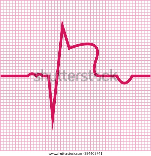 Acute Myocardial Infarction Ecg