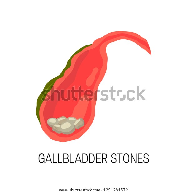 Vektor Stok Biliary Tract Disease Concept Medical Illustration Tanpa