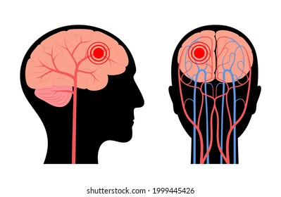 Infarct Images Stock Photos Vectors Shutterstock