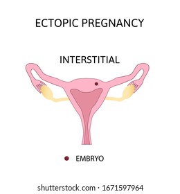 Ectopic Pregnancy Types Extrauterine Pregnancy Interstitial Stock