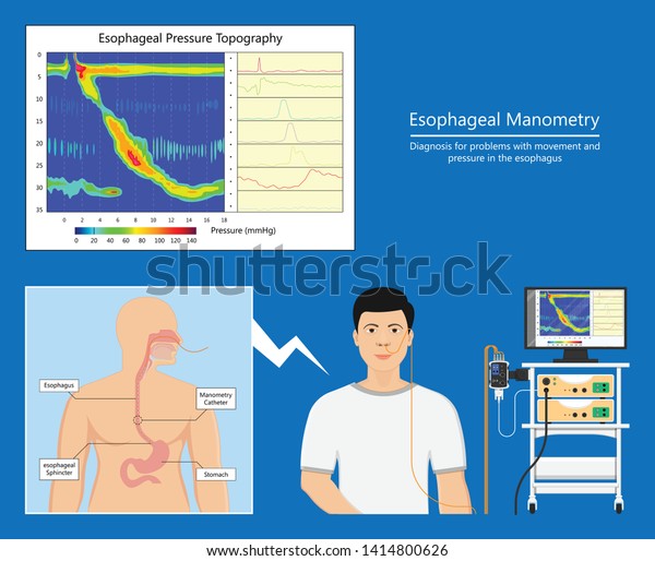 Esophageal Manometry Test Esophageal Diagnose Food Stock Vector