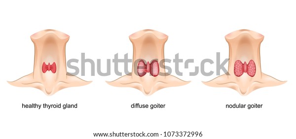 Goiter Thyroid Gland Stock Vector Royalty Free 1073372996