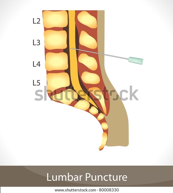 Lumbar Puncture Anatomy