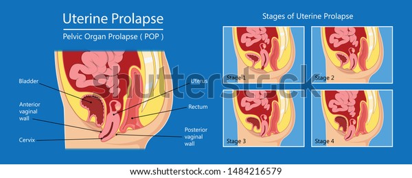 Pelvic Floor Prolapse Type Uterine Uterusのベクター画像素材ロイヤリティフリー Shutterstock