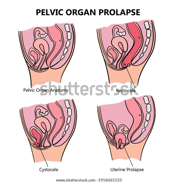Pelvic Organ Prolapse Variously Women General Stock Vector Royalty Free Shutterstock