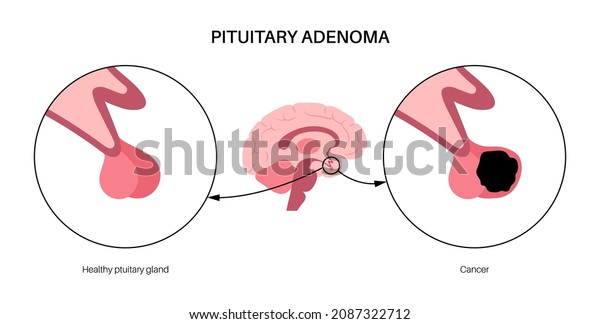 Pituitary Adenoma Concept Tumor Human Brain Stock Vector Royalty Free