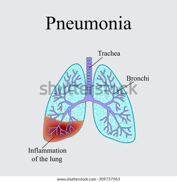 Pneumonia Anatomical Structure Human Lung Vector Stock Vector Royalty