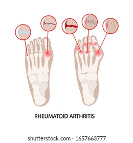 Rheumatoid Disease Leg Arthritis Medicine Education Stock Vector Royalty Free