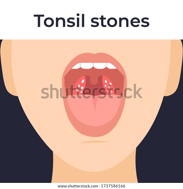Tonsil Stones Throat Tonsilloliths Flat Cartoon The Best Porn Website