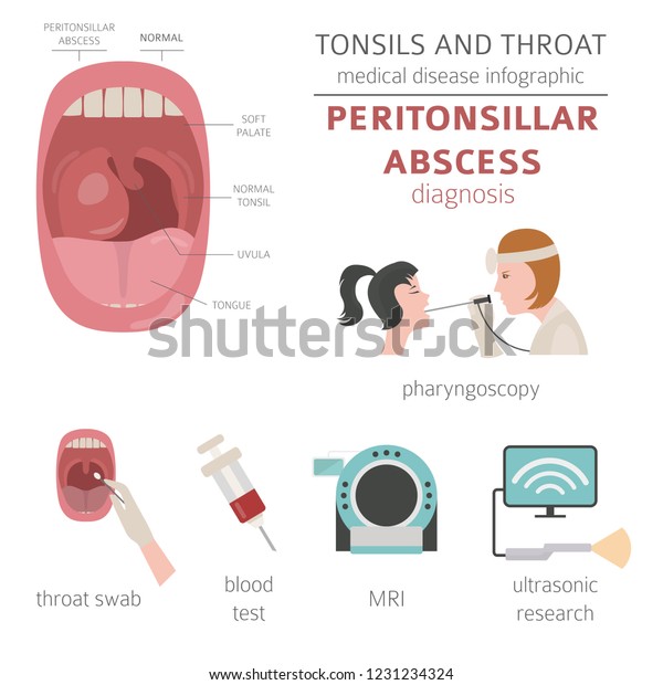 Tonsils Throat Diseases Peritonsillar Abscess Symptoms Stock Vector Royalty Free