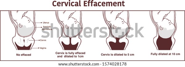 Vector Cervical Effacement Dilatation During Labor Stock Vector