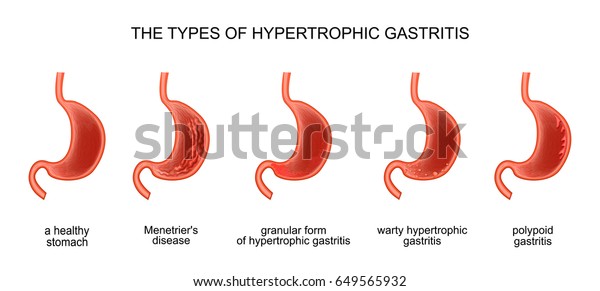 Vector Illustration Types Hypertrophic Gastritis Stock Vector Royalty