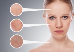concept skincare. Skin of beauty young woman before and after the procedure on a gray background