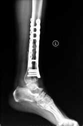Tibiofibula fracture fixation surgery, left lateral position X-ray pictures