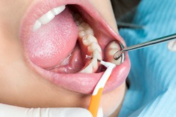 Macro close up of hands doing inter dental cleaning on human teeth.Human mouth wide open with inter dental brush between teeth.