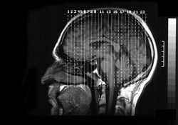 MRI (magnetic resonance image)of a human brain from side view.