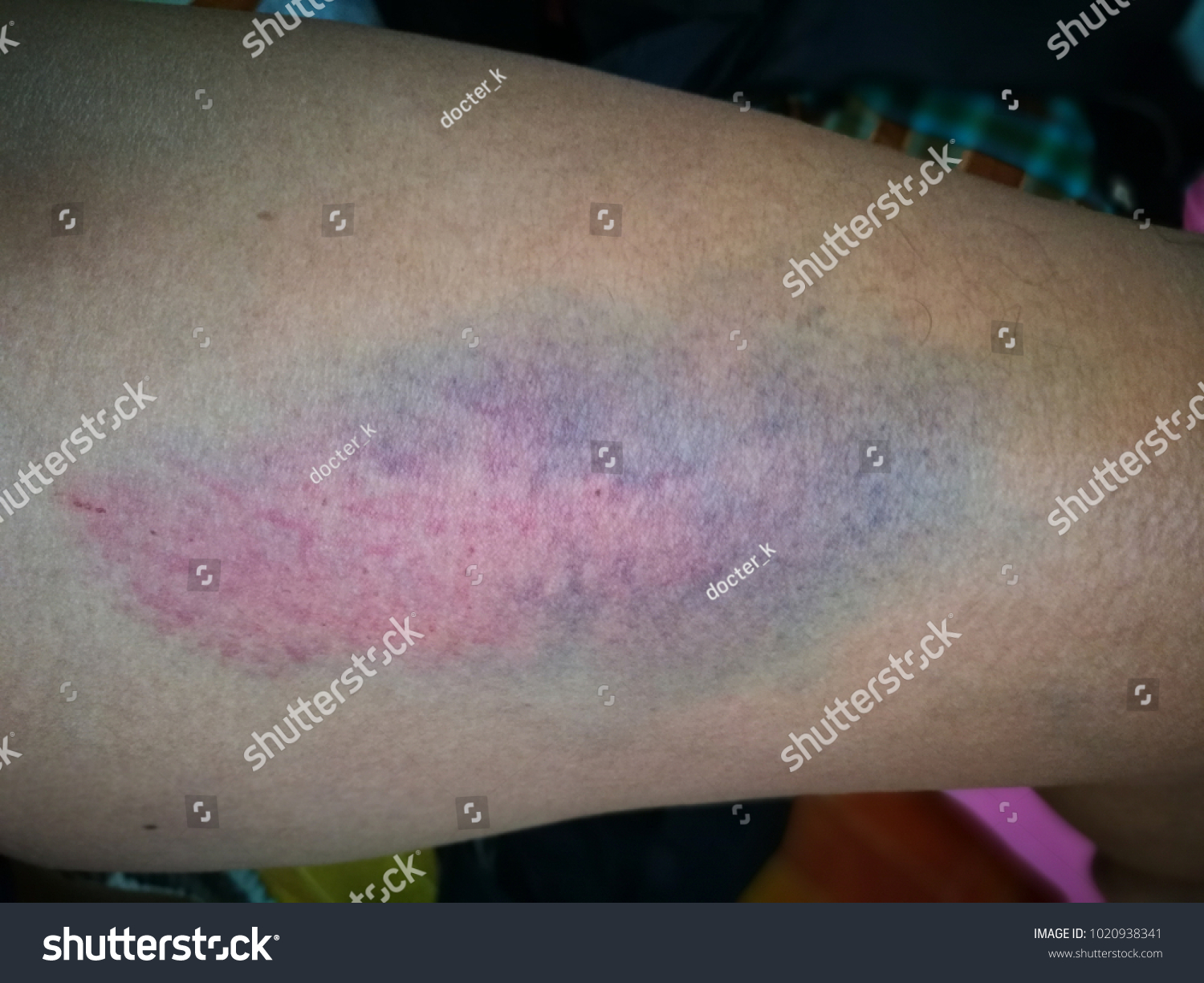 Skin Disease Lesion Ecchymosis Vasculitis Nursing Stock Photo