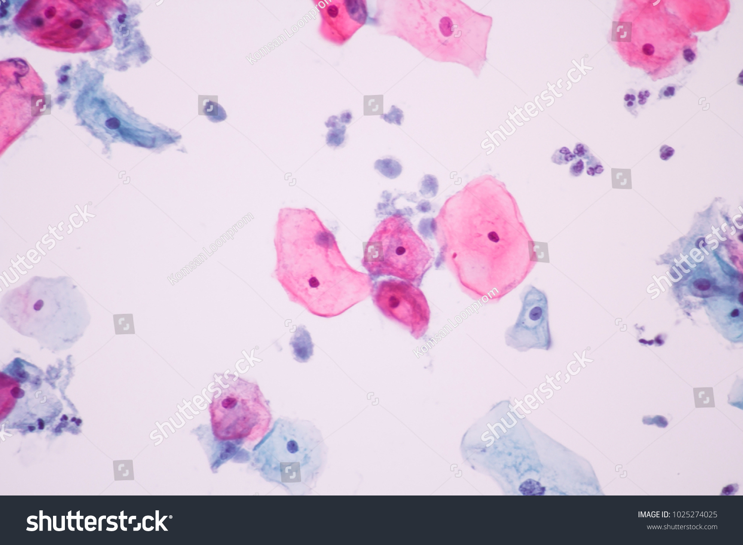 Trichomonas Pap Smear Cytology View Microscopicgynecology Foto De Stock