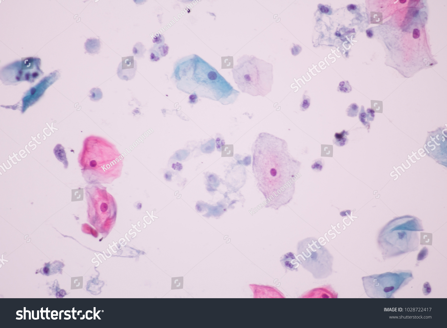 Trichomonas Pap Smear Cytology View Microscopicgynecology Stock