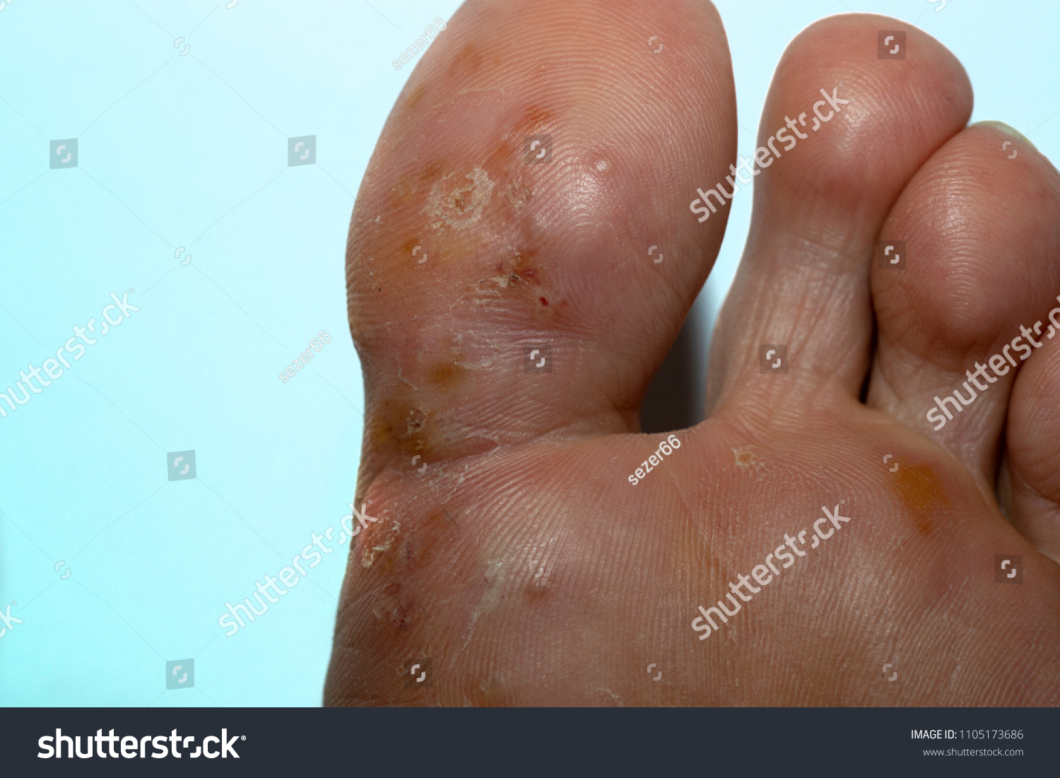 Tinea Pedis Fungal Infection Athletes Foot Stock Photo 1105173686