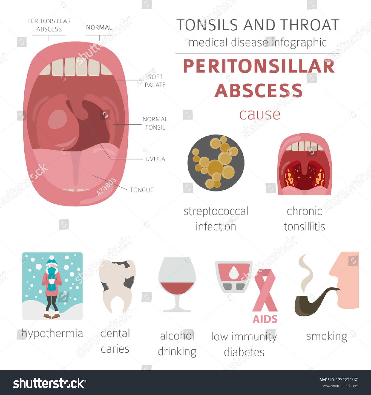 Tonsils Throat Diseases Peritonsillar Abscess Symptoms Stock Vector Royalty Free