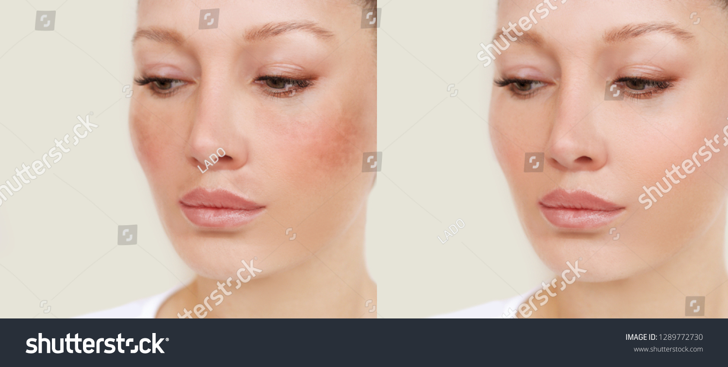 Manchas Escuras Sardas Hiperpigmenta O Melasma Ou Foto Stock