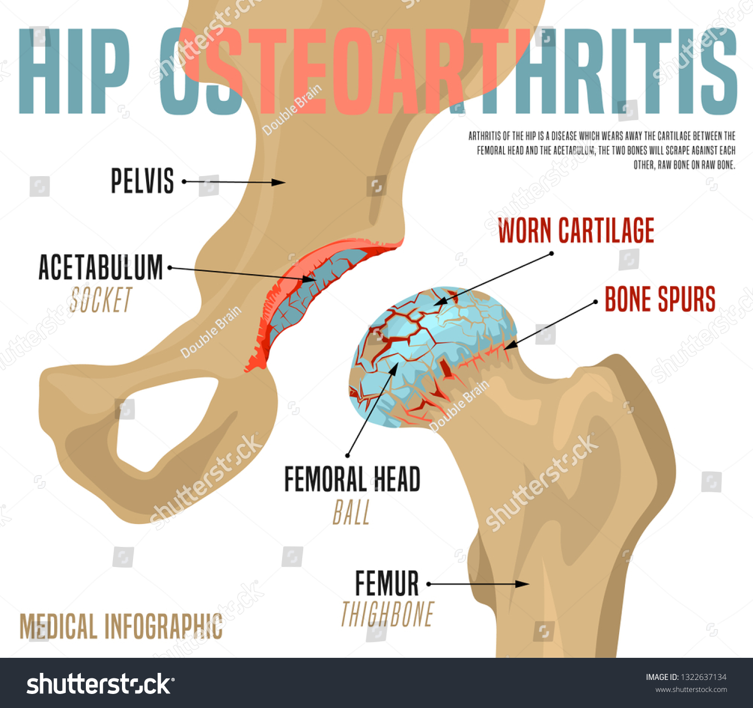 Hip Osteoarthritis Infographic Realistic Bones Scheme Stock Vector