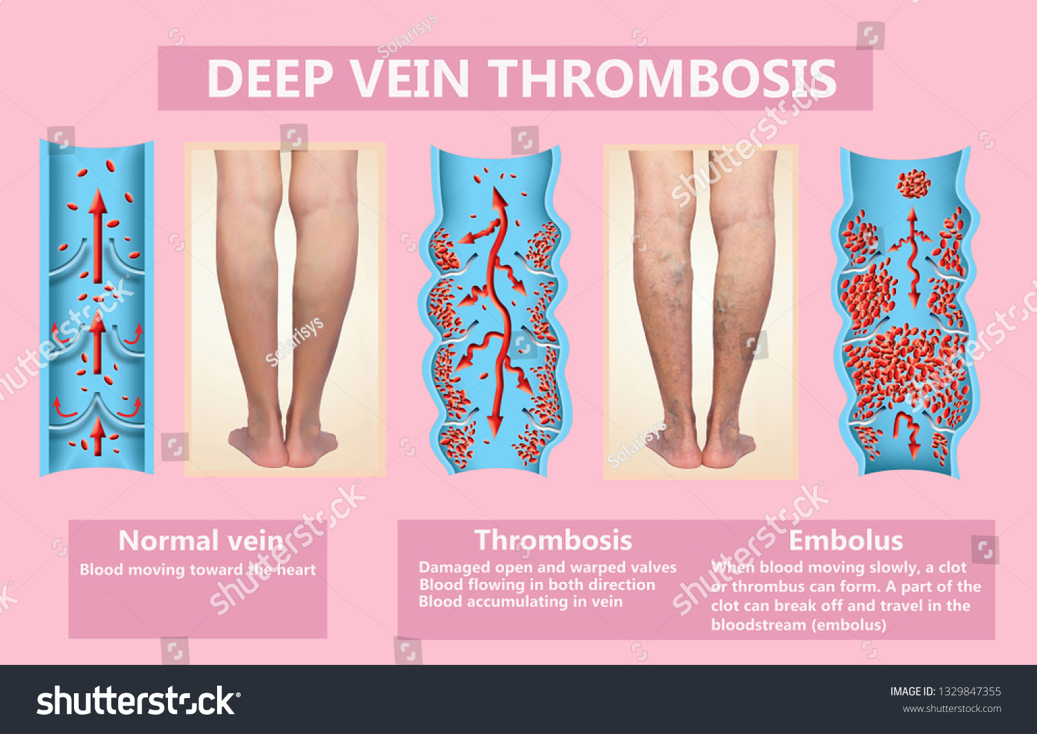 Miroslav Klose Thrombosis