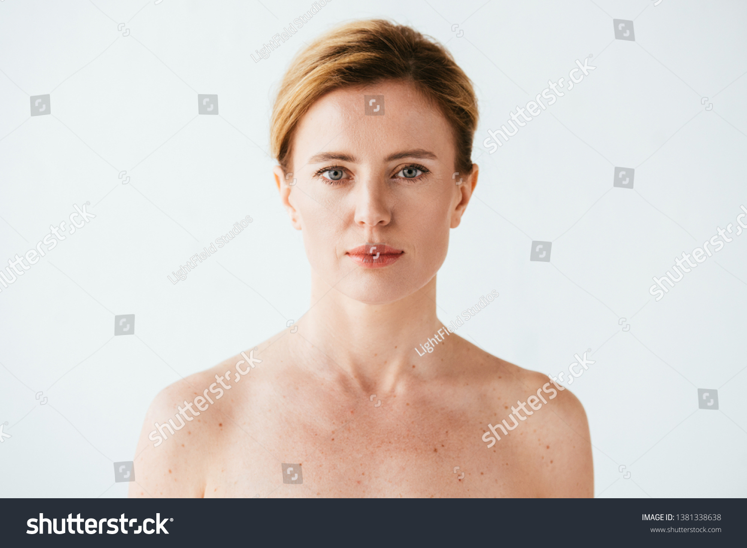 Naked Woman Skin Illness Looking Camera Stock Photo