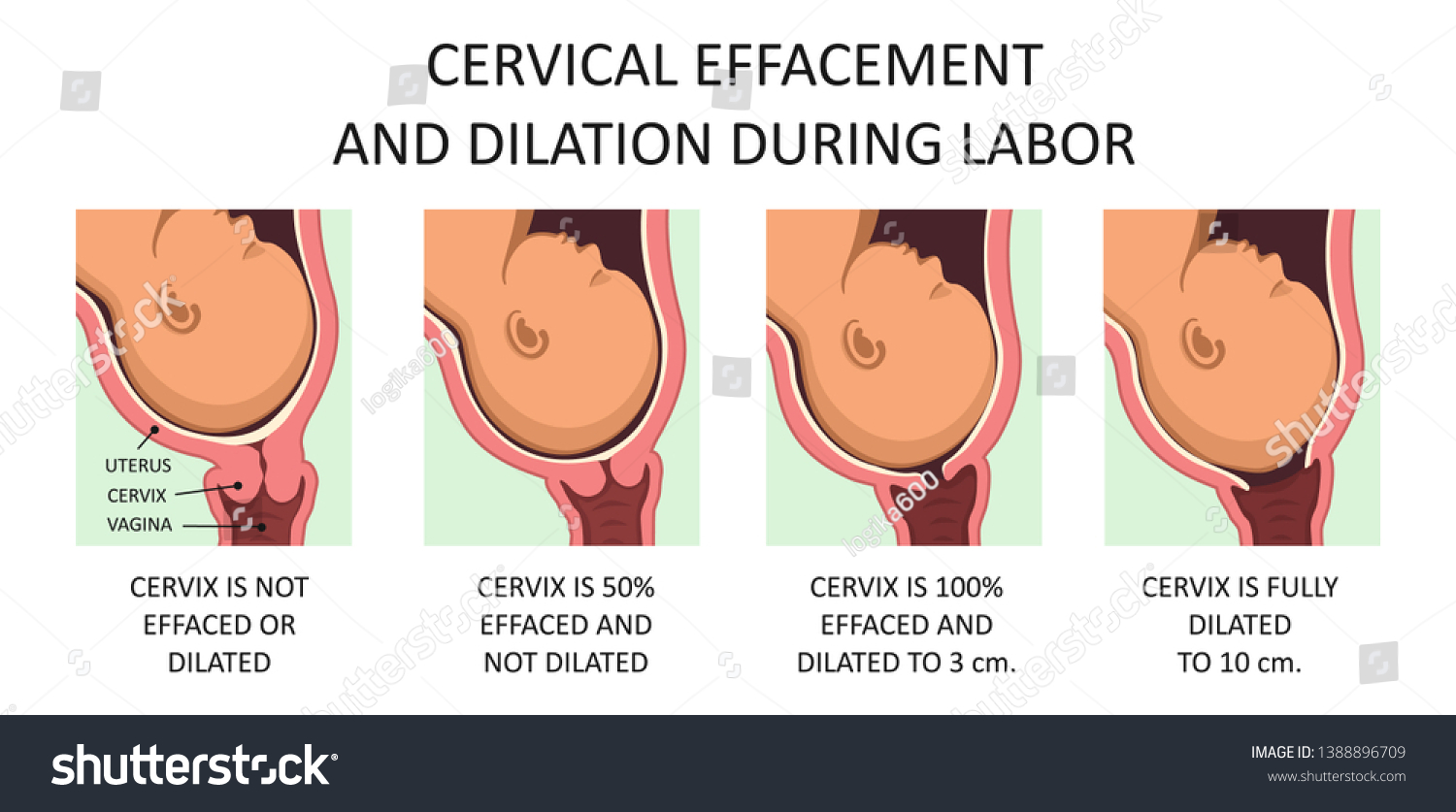 Retraso Y Ensanchamiento De Cervix Durante Vector De Stock Libre De