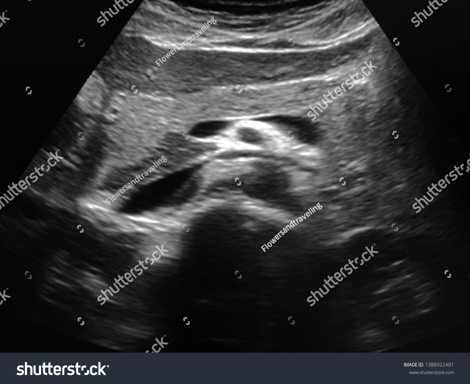 Ultrasound Image Normal Human Pancreas Stock Photo