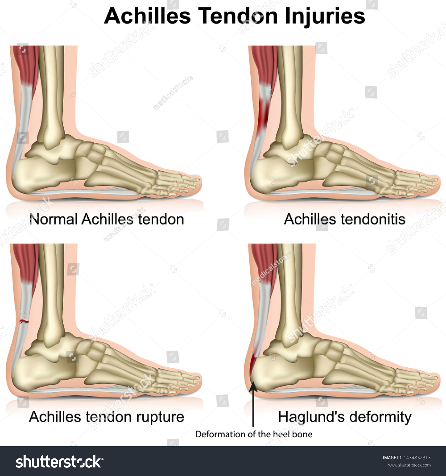 Achilles Tendon Injures Medical Vector Illustration Stock Vector