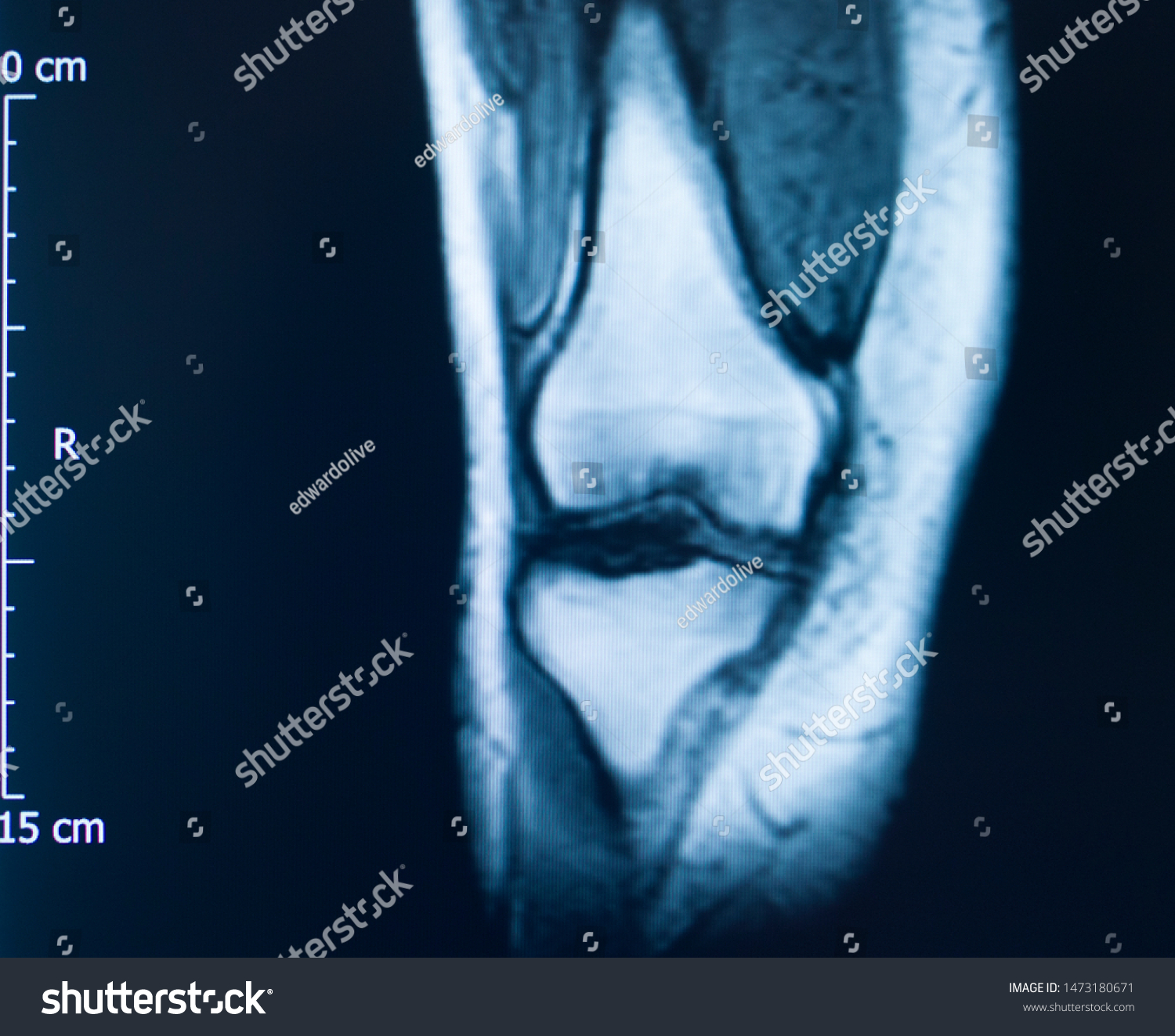 Knee Sports Injury Mri Mcl Grade Foto De Stock Shutterstock