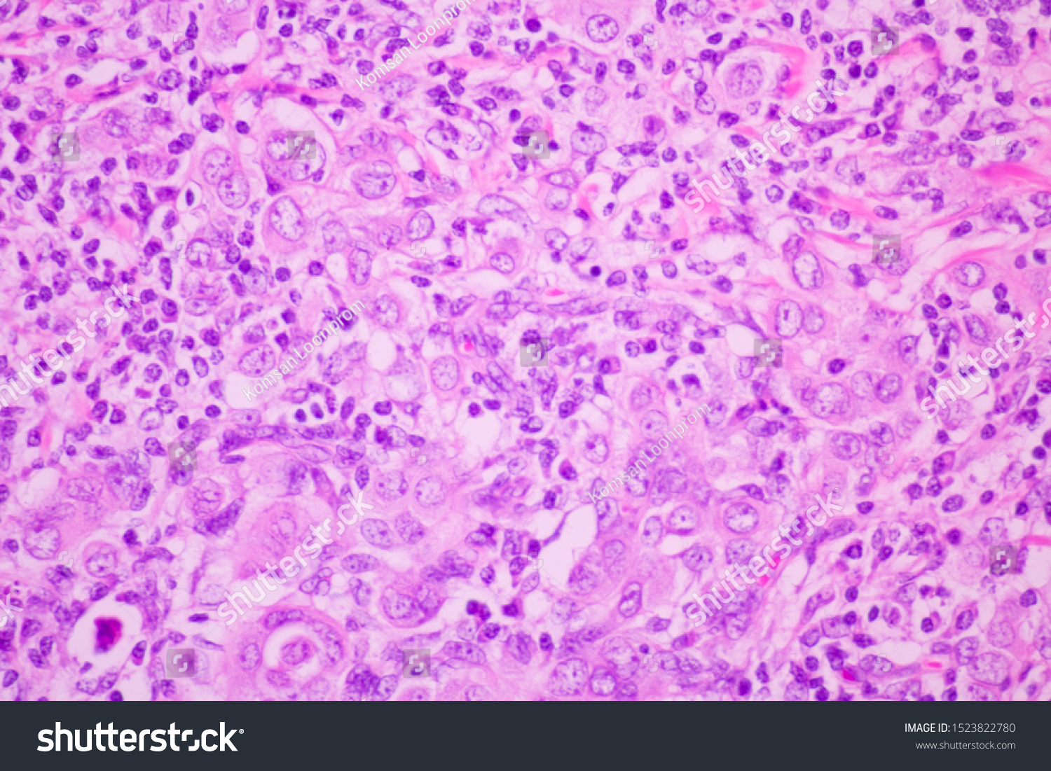 Section Tissue Breast Cancer View Microscopyductal Stock Photo