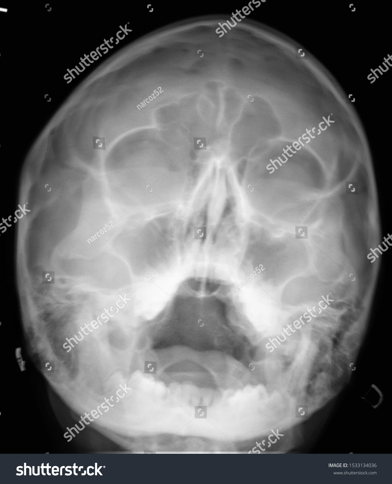 Normal Radiography Paranasal Sinuses Facial Skull Stock Photo