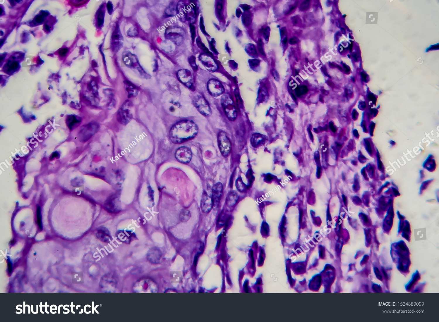 Bladder Carcinoma Shutterstock