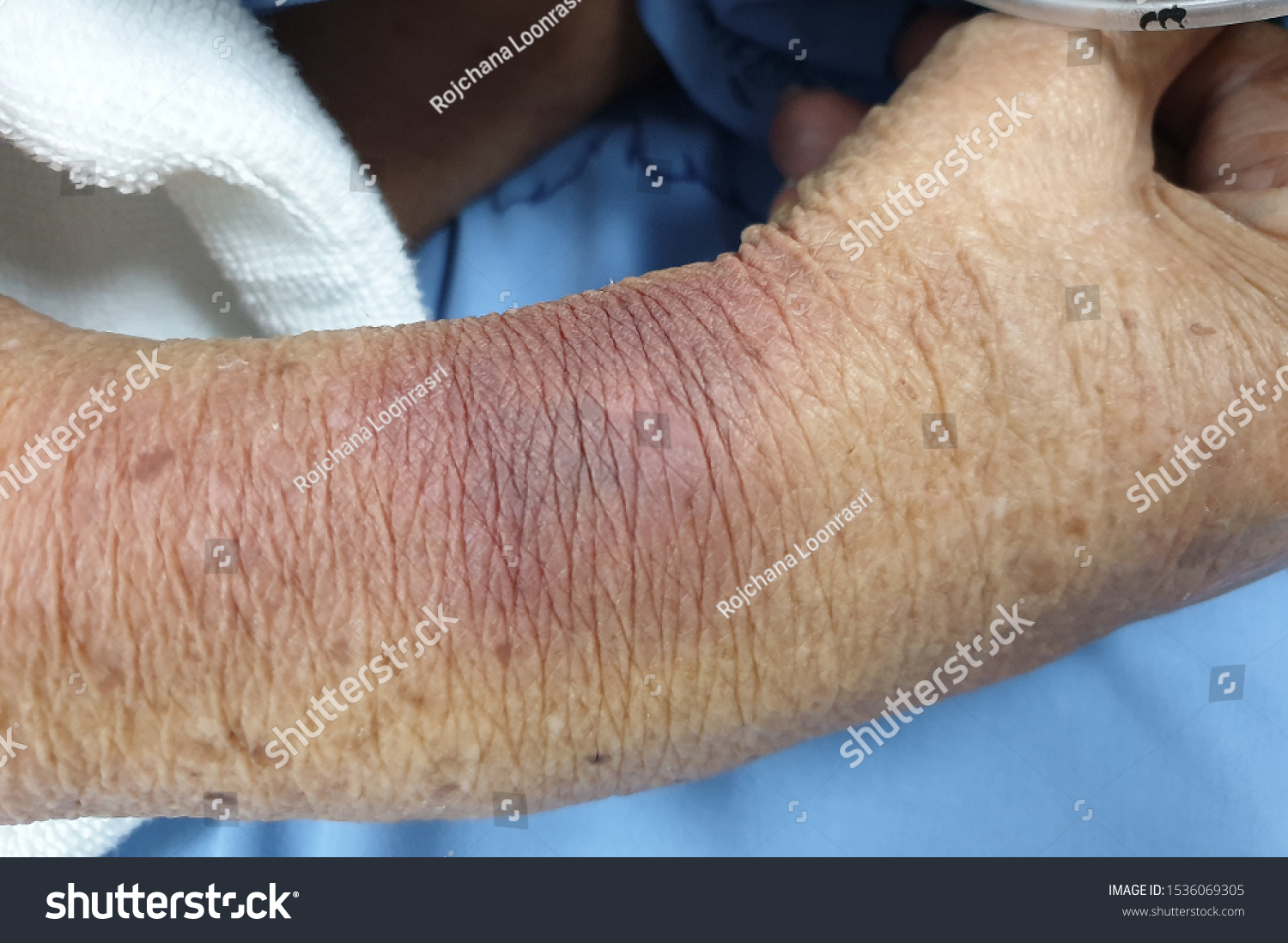 Skin Disease Lesion Ecchymosis Vasculitis Stock Photo