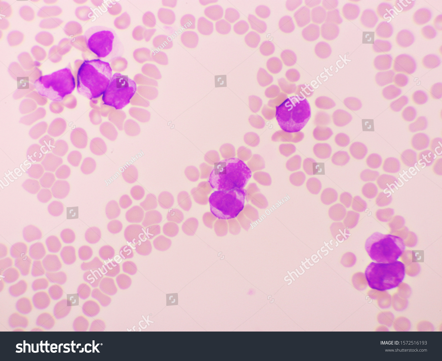 Acute Promyelocytic Leukemia Cells Apl Analyze Stock Photo 1572516193