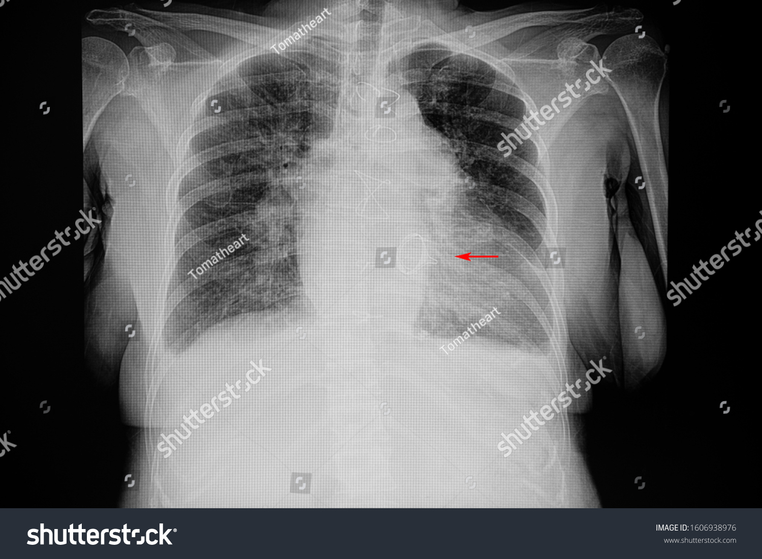 Chest Xray Film Female Patient Cardiomegaly Stock Photo