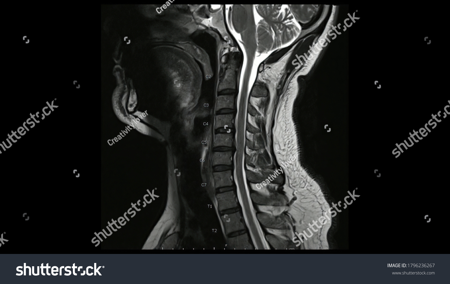 Magnetic Resonance Images Cervical Spine Sagittal Stock Photo