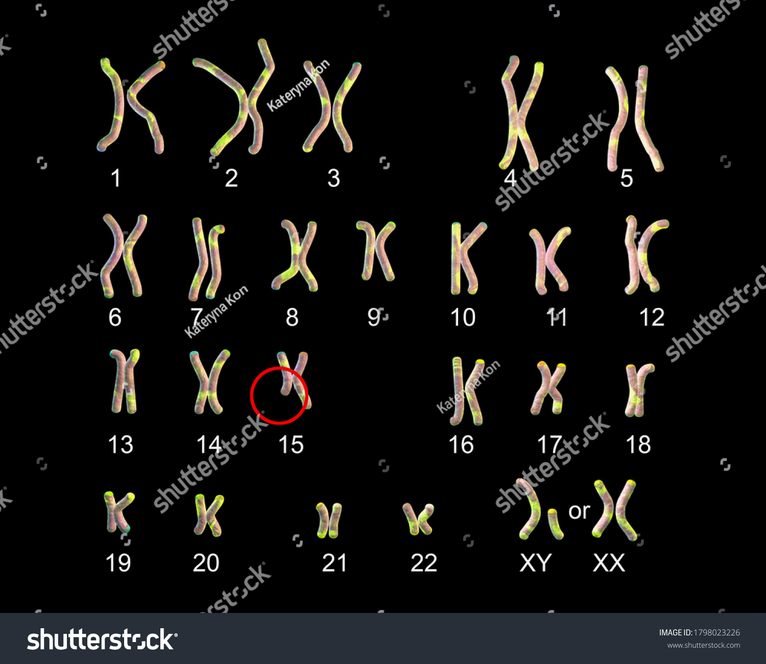 Ilustrasi Stok Karyotype Angelman Syndrome Labelled D Illustration