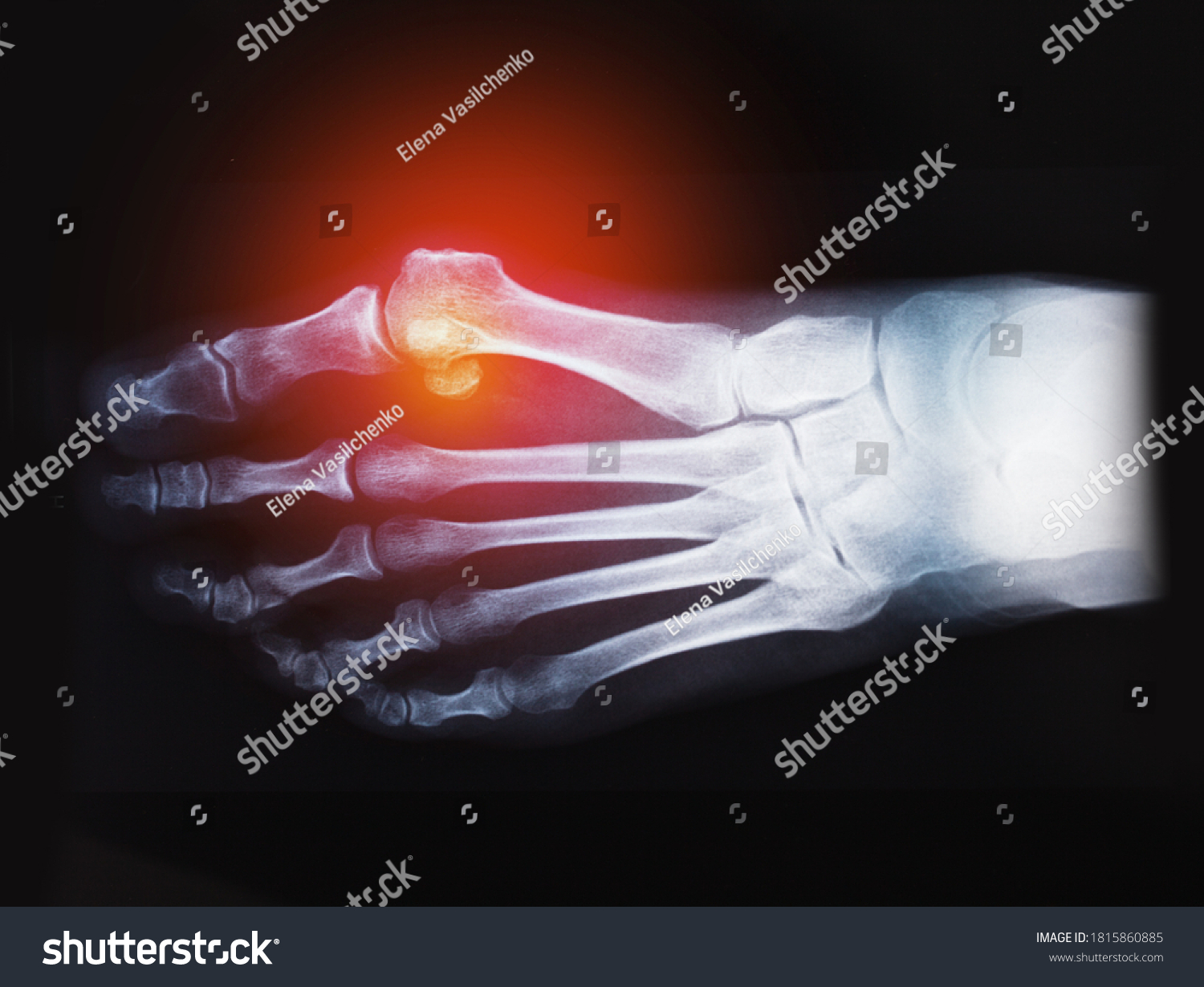 Film Xray Foot Rdiograph Hallux Valgus Stock Photo 1815860885