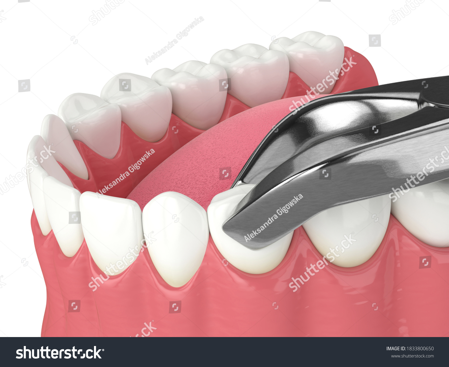 D Render Lower Jaw Tooth Extracted Stock Illustration