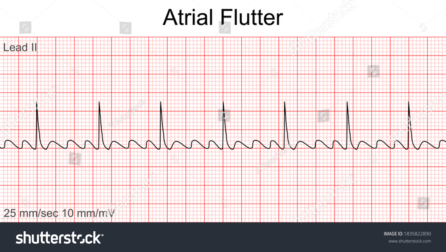 Vektor Stok Electrocardiogram Show Atrial Flutter Pattern Cardiac
