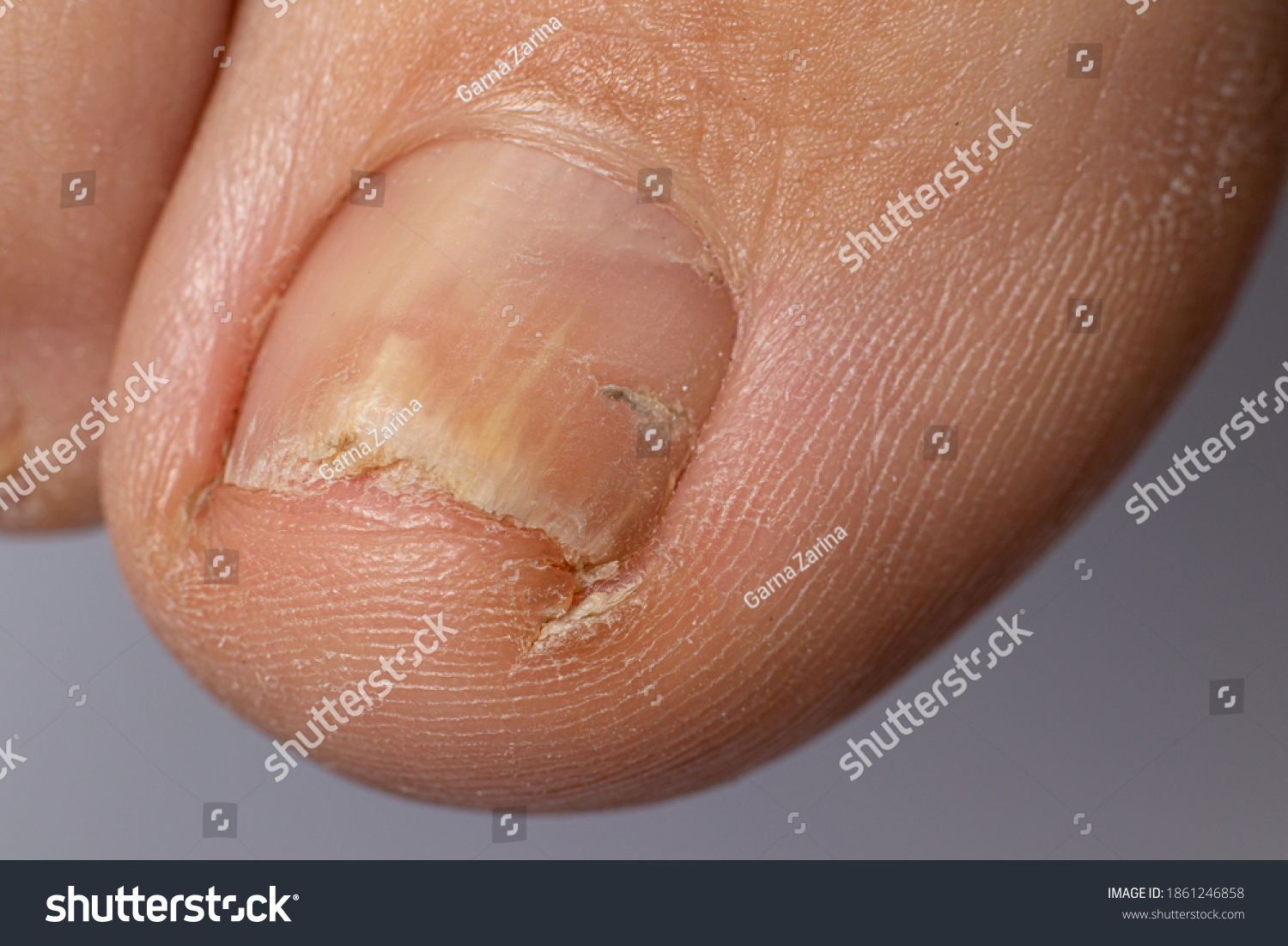 Fungus Nails On Big Toe Dermatomycosis Stock Photo