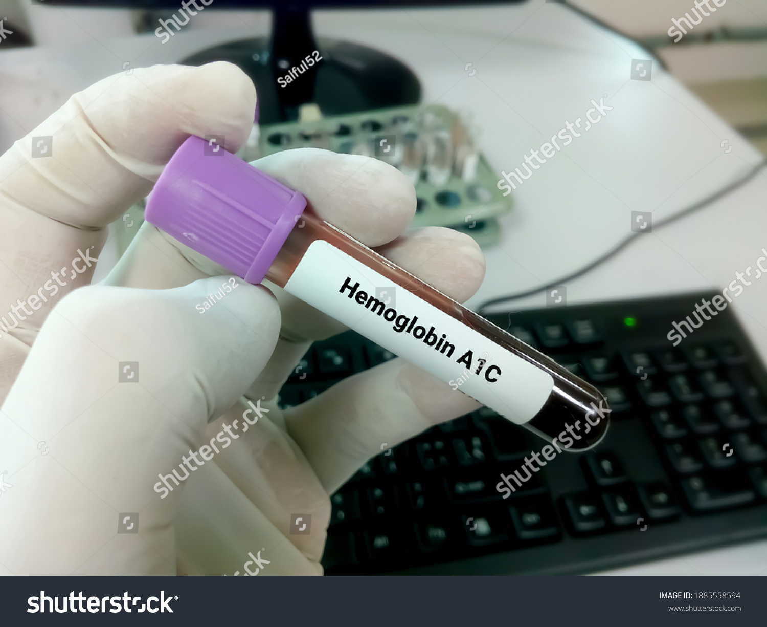 Blood Sample Hba1c Hemoglobin A1c Diabetic库存照片1885558594 Shutterstock